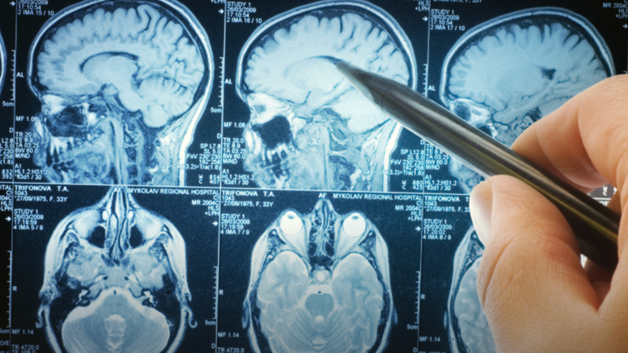 C9orf72-mutatie verzwakt de immuuncellen van de hersenen