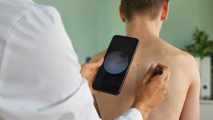 Studie UZ Gent: app voor huidkankerdetectie mist plekken en slaat vals alarm